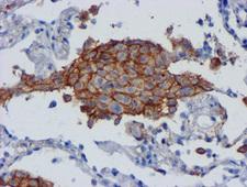 CD80 Antibody - IHC of paraffin-embedded Carcinoma of Human lung tissue using anti-CD80 mouse monoclonal antibody.
