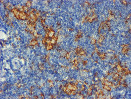 CD80 Antibody - IHC of paraffin-embedded Human lymphoma tissue using anti-CD80 mouse monoclonal antibody.