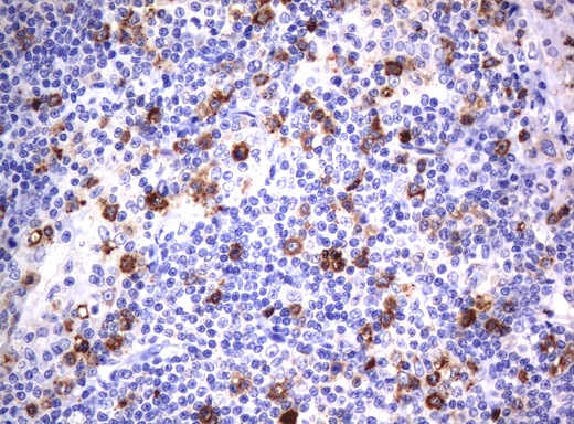CD80 Antibody - Immunohistochemical staining of paraffin-embedded Human lymphoma tissue using anti-CD80 mouse monoclonal antibody.  heat-induced epitope retrieval by 10mM citric buffer, pH6.0, 120C for 3min)