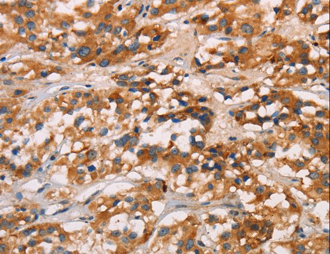 CD80 Antibody - Immunohistochemistry of paraffin-embedded Human gastric cancer using CD80 Polyclonal Antibody at dilution of 1:50.