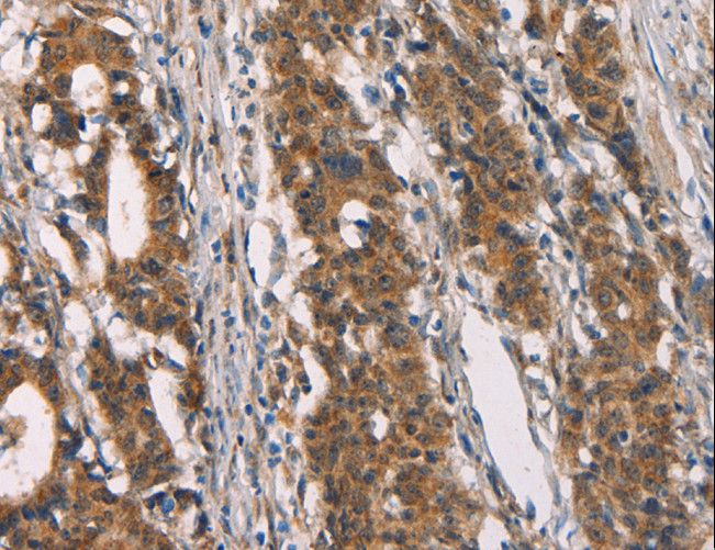 CD80 Antibody - Immunohistochemistry of paraffin-embedded Human gastric cancer using CD80 Polyclonal Antibody at dilution of 1:50.