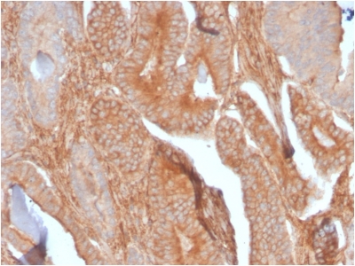 CD81 Antibody - Formalin-fixed, paraffin-embedded human Prostate Carcinoma stained with CD81 Rabbit Recombinant Monoclonal Antibody (C81/2885R).
