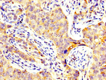 CD82 Antibody - Immunohistochemistry image at a dilution of 1:300 and staining in paraffin-embedded human pancreatic cancer performed on a Leica BondTM system. After dewaxing and hydration, antigen retrieval was mediated by high pressure in a citrate buffer (pH 6.0) . Section was blocked with 10% normal goat serum 30min at RT. Then primary antibody (1% BSA) was incubated at 4 °C overnight. The primary is detected by a biotinylated secondary antibody and visualized using an HRP conjugated SP system.