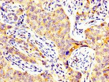CD82 Antibody - Immunohistochemistry image at a dilution of 1:300 and staining in paraffin-embedded human pancreatic cancer performed on a Leica BondTM system. After dewaxing and hydration, antigen retrieval was mediated by high pressure in a citrate buffer (pH 6.0) . Section was blocked with 10% normal goat serum 30min at RT. Then primary antibody (1% BSA) was incubated at 4 °C overnight. The primary is detected by a biotinylated secondary antibody and visualized using an HRP conjugated SP system.