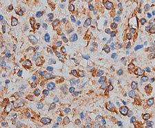 CD82 Antibody - 1:200 staining human lymph carcinoma tissue by IHC-P. The tissue was formaldehyde fixed and a heat mediated antigen retrieval step in citrate buffer was performed. The tissue was then blocked and incubated with the antibody for 1.5 hours at 22°C. An HRP conjugated goat anti-rabbit antibody was used as the secondary.