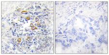 CD83 Antibody - Immunohistochemistry analysis of paraffin-embedded human lung carcinoma, using CD83 Antibody. The picture on the right is blocked with the synthesized peptide.