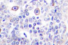 CD83 Antibody - IHC of CD83 (P130) pAb in paraffin-embedded human lung carcinoma tissue.