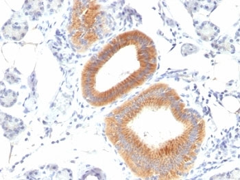 CD86 Antibody - Formalin-fixed, paraffin-embedded human melanoma stained with CD86 antibody (C86/1146).  This image was taken for the unmodified form of this product. Other forms have not been tested.