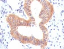 CD86 Antibody - IHC testing of FFPE human melanoma with CD86 antibody (clone CDLA86).  This image was taken for the unmodified form of this product. Other forms have not been tested.