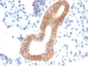 CD86 Antibody - Formalin-fixed, paraffin-embedded human melanoma stained with CD86 antibody (SPM600).  This image was taken for the unmodified form of this product. Other forms have not been tested.