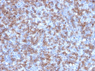 CD8A / CD8 Alpha Antibody - Formalin-fixed, paraffin-embedded human Lymphoma stained with CD8a Rabbit Recombinant Monoclonal Antibody (C8/1779R).