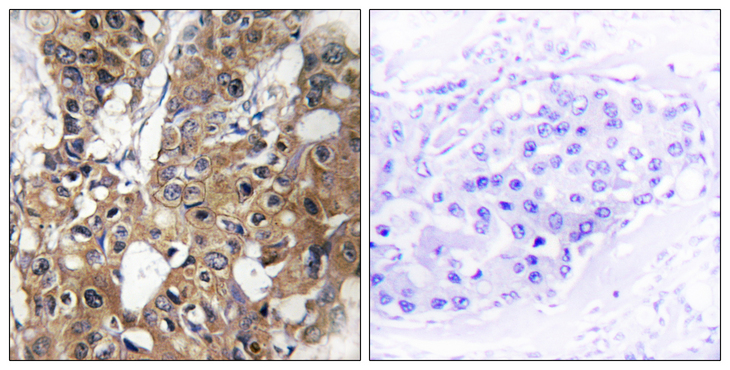 CD9 Antibody - Immunohistochemistry analysis of paraffin-embedded human breast carcinoma tissue, using CD9 Antibody. The picture on the right is blocked with the synthesized peptide.