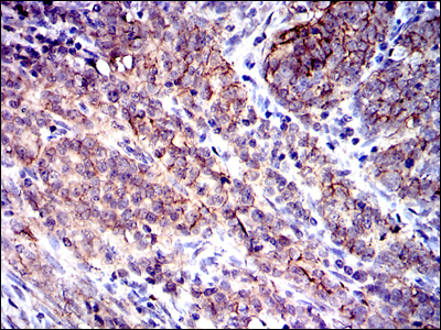 CD9 Antibody - IHC of paraffin-embedded cervical cancer tissues using CD9 mouse monoclonal antibody with DAB staining.
