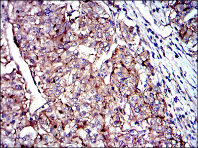 CD9 Antibody - IHC of paraffin-embedded kidney cancer tissues using CD9 mouse monoclonal antibody with DAB staining.