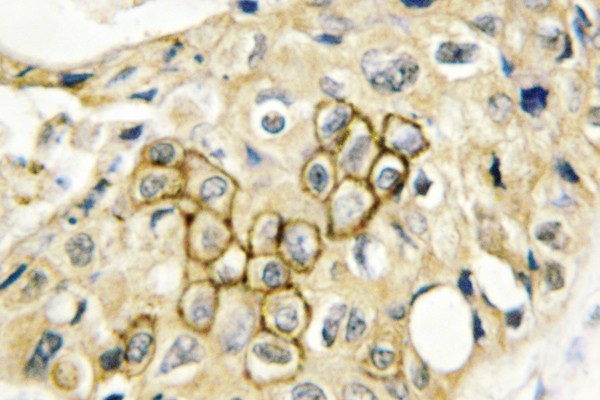 CD9 Antibody - IHC of CD9 (Y129) pAb in paraffin-embedded human breast carcinoma tissue.