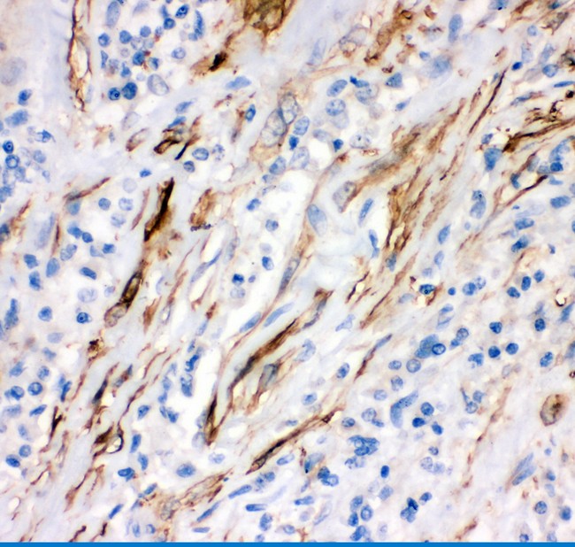 CD95 / FAS Antibody - FAS antibody IHC-paraffin: Human Lung Cancer Tissue.