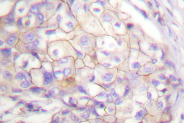 CD95 / FAS Antibody - IHC of FAS (L315) pAb in paraffin-embedded human breast carcinoma tissue.