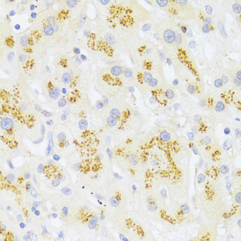 CD95 / FAS Antibody - Immunohistochemistry of paraffin-embedded human liver cancer using FAS Antibodyat dilution of 1:100 (40x lens).