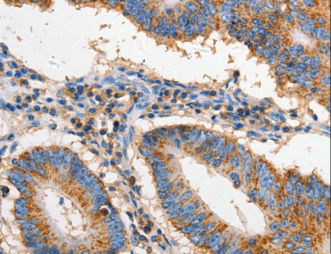 CD95 / FAS Antibody - Immunohistochemistry of paraffin-embedded Human colon cancer using FAS Polyclonal Antibody at dilution of 1:60.