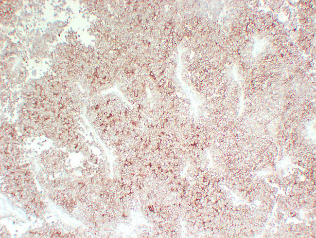 CD99 Antibody - Ewing'S Sarcoma 1
