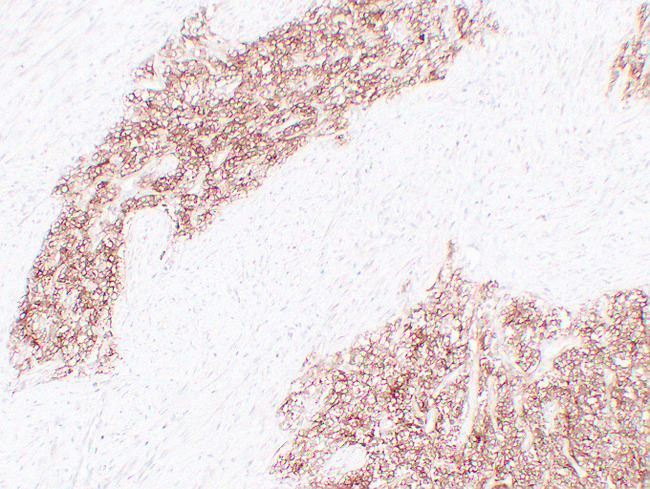 CD99 Antibody - Ewing'S Sarcoma 2