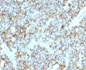 CD99 Antibody - IHC testing of FFPE human Ewing's sarcoma and CD99 antibody (clone CDLA99).  This image was taken for the unmodified form of this product. Other forms have not been tested.