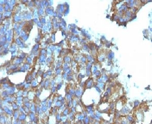 CD99 Antibody - IHC testing of FFPE human ovarian carcinoma and CD99 antibody (clone CDLA99).  This image was taken for the unmodified form of this product. Other forms have not been tested.