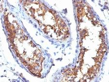 CD99 Antibody - Formalin-fixed, paraffin-embedded human testicular carcinoma stained with CD99 antibody (HO36-1.1).  This image was taken for the unmodified form of this product. Other forms have not been tested.