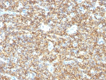 CD99 Antibody - Formalin-fixed, paraffin-embedded human Ewing's sarcoma stained with CD99 antibody (HO36-1.1).  This image was taken for the unmodified form of this product. Other forms have not been tested.