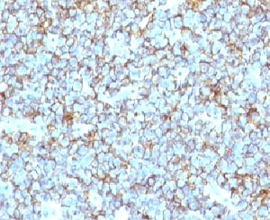 CD99 Antibody - Formalin-fixed, paraffin-embedded human Ewing's sarcoma stained with CD99 antibody (MIC2/877).  This image was taken for the unmodified form of this product. Other forms have not been tested.