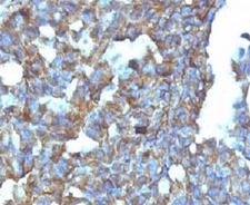 CD99 Antibody - Formalin-fixed, paraffin-embedded human ovarian carcinoma stained with CD99 antibody (MIC2/877).  This image was taken for the unmodified form of this product. Other forms have not been tested.