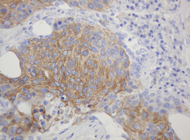 CD99 Antibody - IHC of paraffin-embedded Carcinoma of Human lung tissue using anti-CD99 mouse monoclonal antibody.