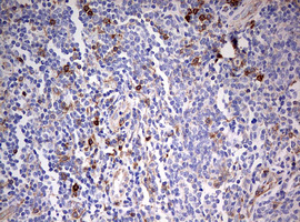CD99 Antibody - IHC of paraffin-embedded Human lymphoma tissue using anti-CD99 mouse monoclonal antibody. (Heat-induced epitope retrieval by 10mM citric buffer, pH6.0, 120°C for 3min).