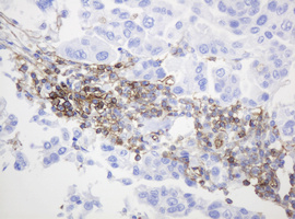 CD99 Antibody - IHC of paraffin-embedded Carcinoma of Human bladder tissue using anti-CD99 mouse monoclonal antibody.