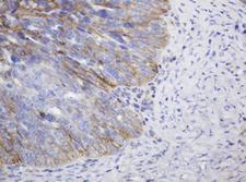 CD99 Antibody - IHC of paraffin-embedded Adenocarcinoma of Human ovary tissue using anti-CD99 mouse monoclonal antibody.