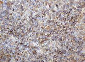 CD99 Antibody - IHC of paraffin-embedded Human lymphoma tissue using anti-CD99 mouse monoclonal antibody.
