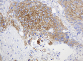 CD99 Antibody - IHC of paraffin-embedded Carcinoma of Human lung tissue using anti-CD99 mouse monoclonal antibody.