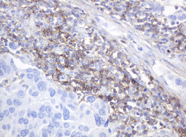 CD99 Antibody - IHC of paraffin-embedded Carcinoma of Human bladder tissue using anti-CD99 mouse monoclonal antibody.