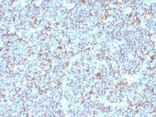 CD99 Antibody - Formalin-fixed, paraffin-embedded human Ewing's sarcoma stained with anti-CD99 antibody (SPM596).  This image was taken for the unmodified form of this product. Other forms have not been tested.
