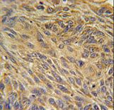 CD99L2 Antibody - CD99L2 Antibody immunohistochemistry of formalin-fixed and paraffin-embedded human lung carcinoma followed by peroxidase-conjugated secondary antibody and DAB staining.
