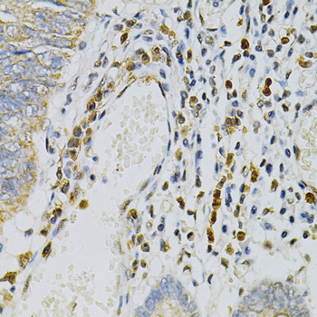 CDA / Cytidine Deaminase Antibody - Immunohistochemistry of paraffin-embedded human colon carcinoma using CDA Antibody at dilution of 1:100 (40x lens).
