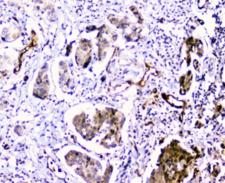 CDA / Cytidine Deaminase Antibody - IHC staining of FFPE human breast cancer with CDA antibody at 1ug/ml. HIER: boil tissue sections in pH6, 10mM citrate buffer, for 10-20 min and allow to cool before testing.