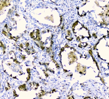 CDA / Cytidine Deaminase Antibody - IHC staining of FFPE human lung cancer with CDA antibody at 1ug/ml. HIER: boil tissue sections in pH6, 10mM citrate buffer, for 10-20 min and allow to cool before testing.