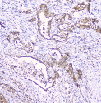 CDA / Cytidine Deaminase Antibody - IHC staining of FFPE human intestinal cancer with CDA antibody at 1ug/ml. HIER: boil tissue sections in pH6, 10mM citrate buffer, for 10-20 min and allow to cool before testing.