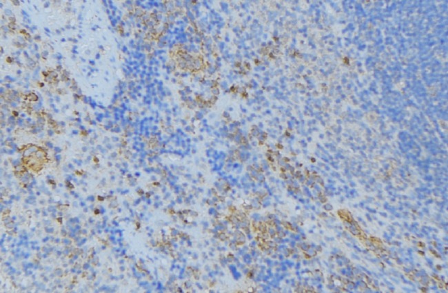 CDA / Cytidine Deaminase Antibody - 1:100 staining human lymph node tissue by IHC-P. The sample was formaldehyde fixed and a heat mediated antigen retrieval step in citrate buffer was performed. The sample was then blocked and incubated with the antibody for 1.5 hours at 22°C. An HRP conjugated goat anti-rabbit antibody was used as the secondary.
