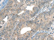 CDADC1 Antibody - Immunohistochemistry of paraffin-embedded Human gastric cancer tissue  using CDADC1 Polyclonal Antibody at dilution of 1:60(×200)