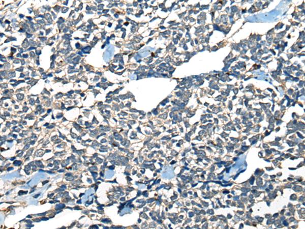 CDADC1 Antibody - Immunohistochemistry of paraffin-embedded Human lung cancer tissue  using CDADC1 Polyclonal Antibody at dilution of 1:60(×200)