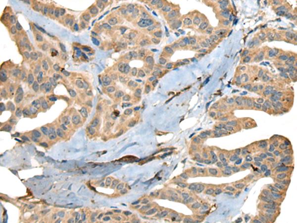 CDADC1 Antibody - Immunohistochemistry of paraffin-embedded Human thyroid cancer tissue  using CDADC1 Polyclonal Antibody at dilution of 1:40(×200)