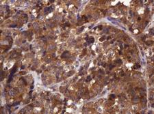 CDC123 Antibody - IHC of paraffin-embedded Adenocarcinoma of Human colon tissue using anti-CDC123 mouse monoclonal antibody. (Heat-induced epitope retrieval by 10mM citric buffer, pH6.0, 120°C for 3min).