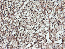 CDC123 Antibody - IHC of paraffin-embedded Carcinoma of Human kidney tissue using anti-CDC123 mouse monoclonal antibody.